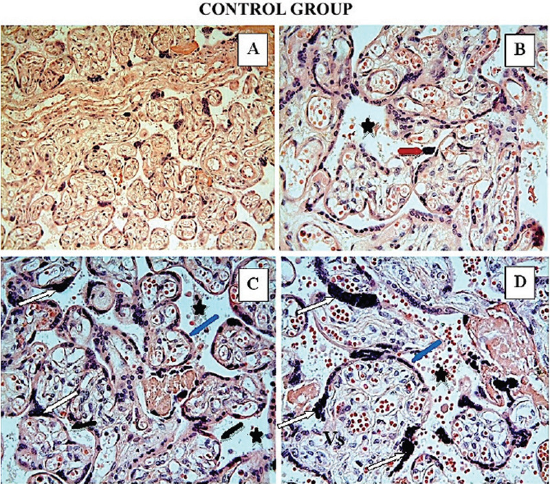 Evaluation of serum neopterin, periostin, Tenascin-C, tissue inhibitor of metalloproteinase-1 and matrix metalloproteinase-2 levels in obese pregnant women