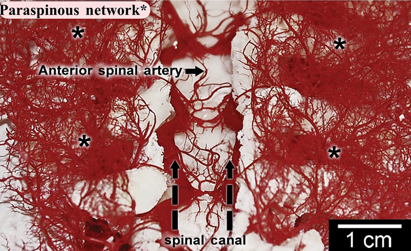 Cerebrospinal Fluid Drainage for Prevention of Spinal Cord Ischemia in Thoracic Endovascular Aortic Surgery-Pros and Cons.