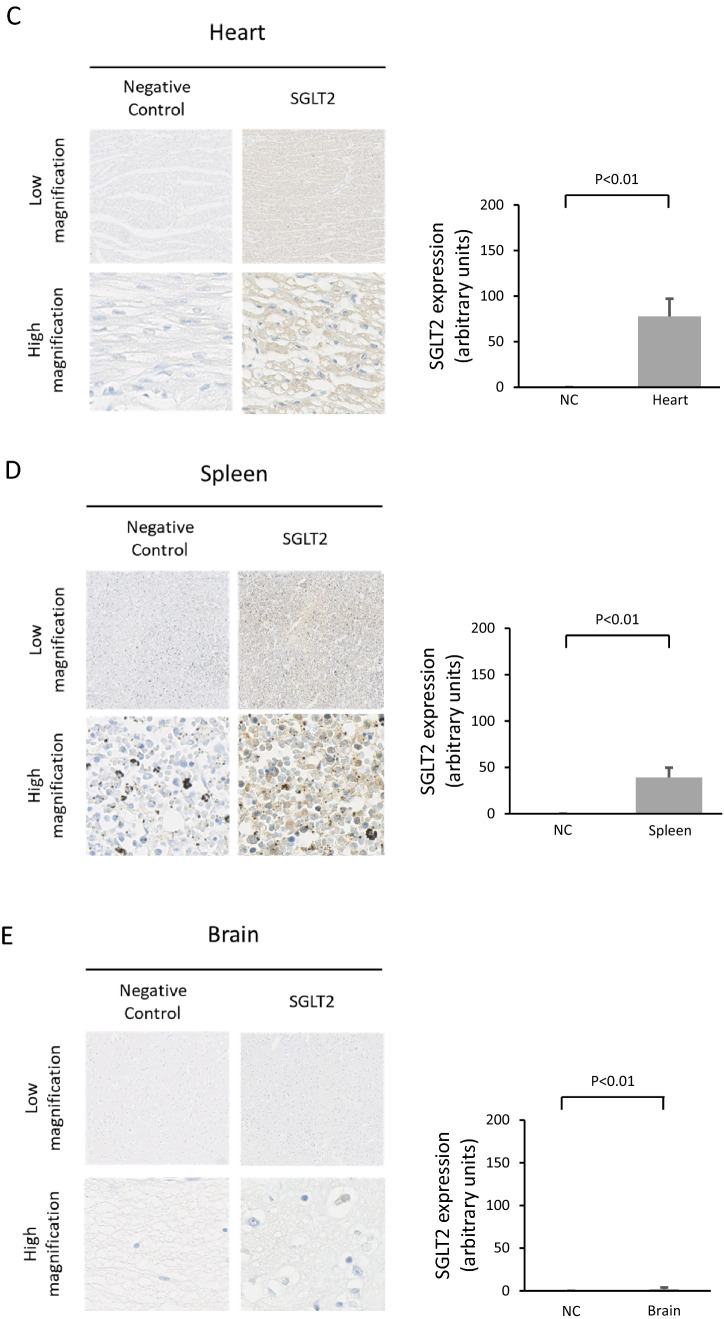 Hepatic expression of sodium-glucose cotransporter 2 (SGLT2) in patients with chronic liver disease.