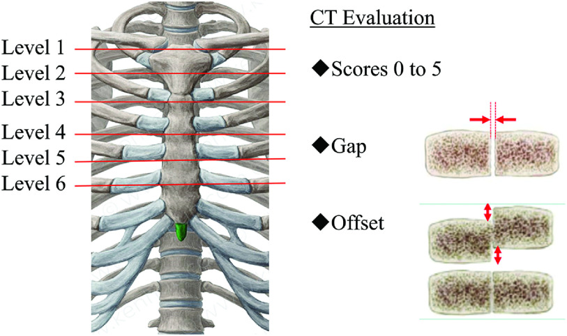 Early Sternal Bone Healing after Thermoreactive Nitinol Flexigrip Sternal Closure.