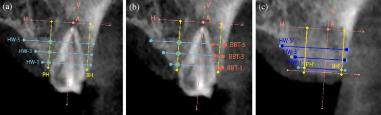 Hard and soft tissue evaluation of alveolar ridge preservation compared to spontaneous healing: a retrospective clinical and volumetric analysis.