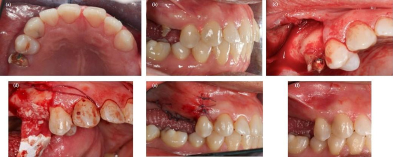 Hard and soft tissue evaluation of alveolar ridge preservation compared to spontaneous healing: a retrospective clinical and volumetric analysis.