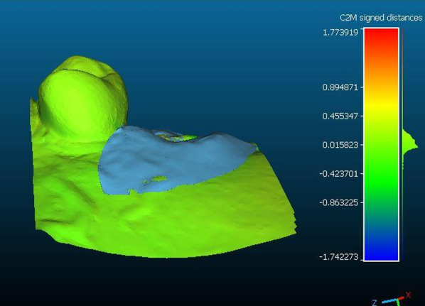 Hard and soft tissue evaluation of alveolar ridge preservation compared to spontaneous healing: a retrospective clinical and volumetric analysis.