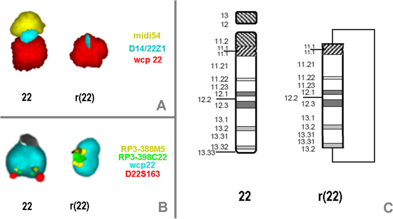 Molecular cytogenetic and phenotypic characterization of Phelan McDermid and 22q13 duplication syndrome: a case report.