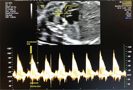 Fetal pulmonary artery Doppler parameters in pregnancies complicated with intrahepatic cholestasis of pregnancy: a prospective case-control study