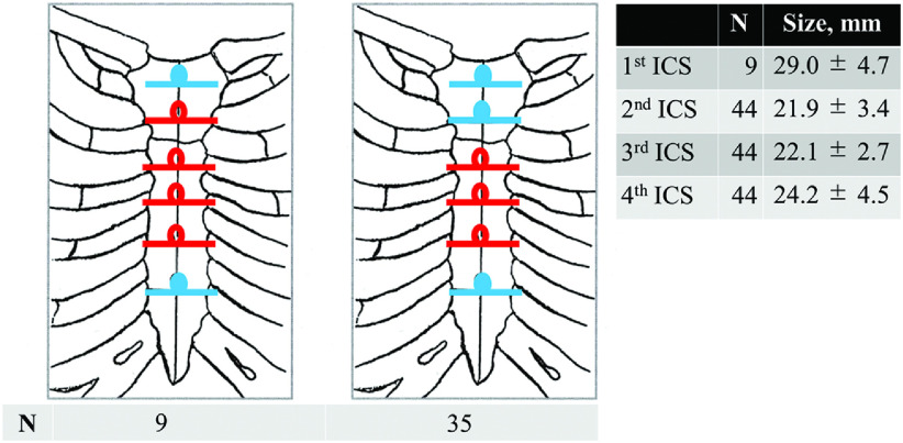 Early Sternal Bone Healing after Thermoreactive Nitinol Flexigrip Sternal Closure.