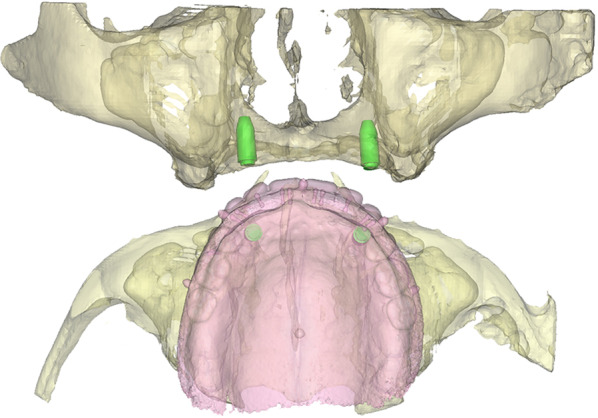 The performance of two-implant overdentures in the atrophic maxilla: a case series with 1-year follow-up.