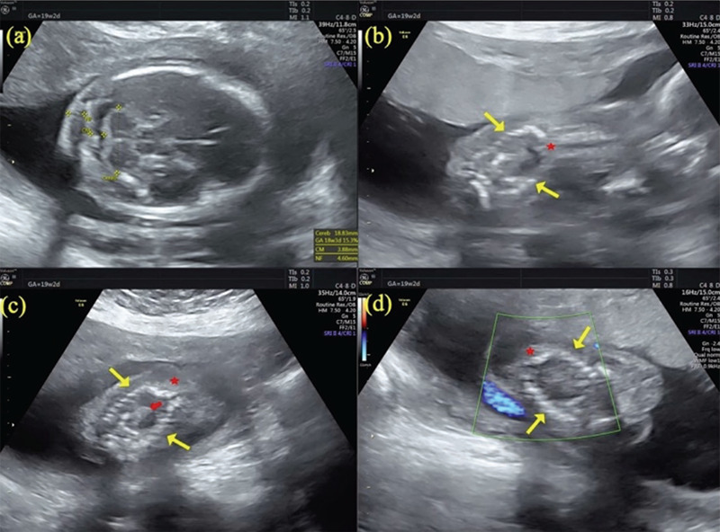 Prenatally diagnosed fetal thoraco-lumbar spine duplication associated with lipomyelomeningocele: An extremely rare case of split cord malformation.