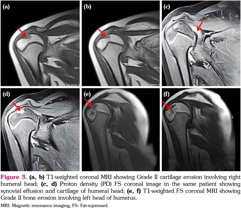 The reliability of Juvenile Arthritis Magnetic Resonance Imaging Scoring system in the evaluation of the shoulder joint in juvenile idiopathic arthritis.