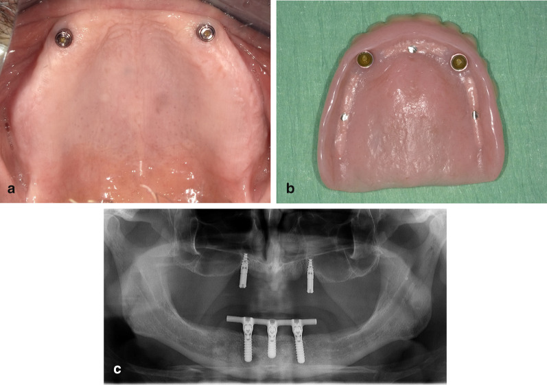 The performance of two-implant overdentures in the atrophic maxilla: a case series with 1-year follow-up.