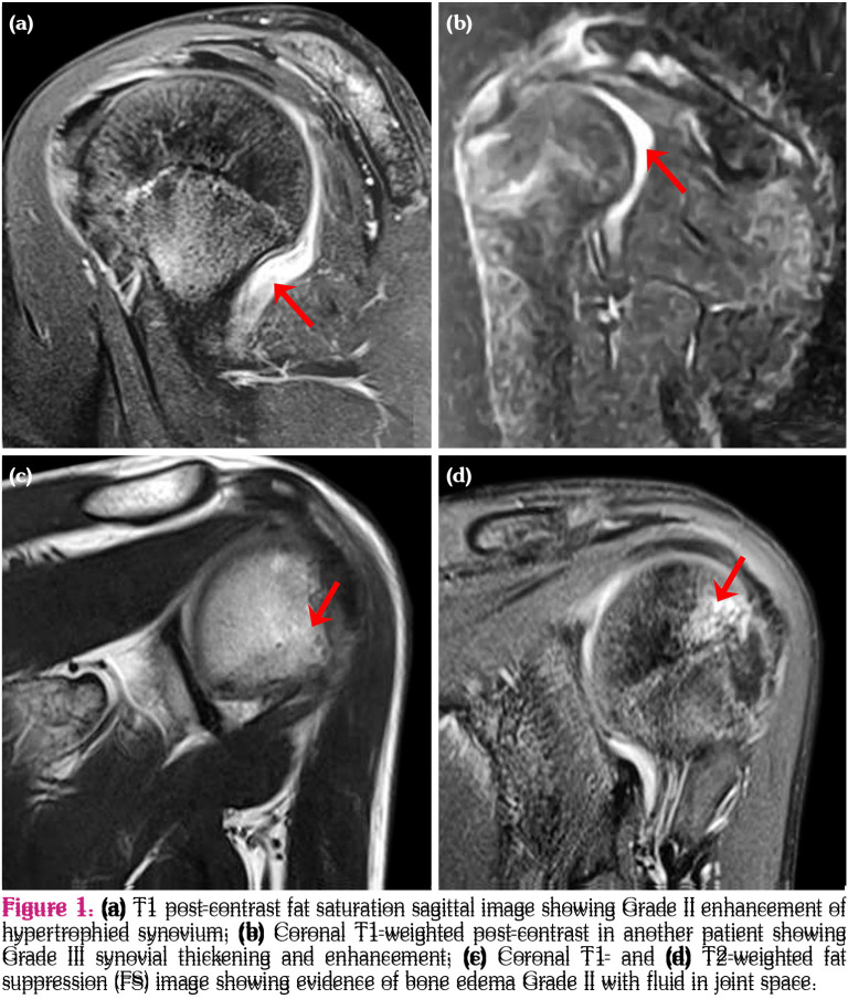 The reliability of Juvenile Arthritis Magnetic Resonance Imaging Scoring system in the evaluation of the shoulder joint in juvenile idiopathic arthritis.