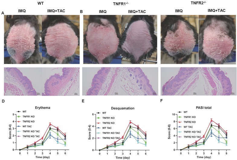 The Therapeutic Effect of Tacrolimus in a Mouse Psoriatic Model is Associated with the Induction of Myeloid-derived Suppressor Cells.