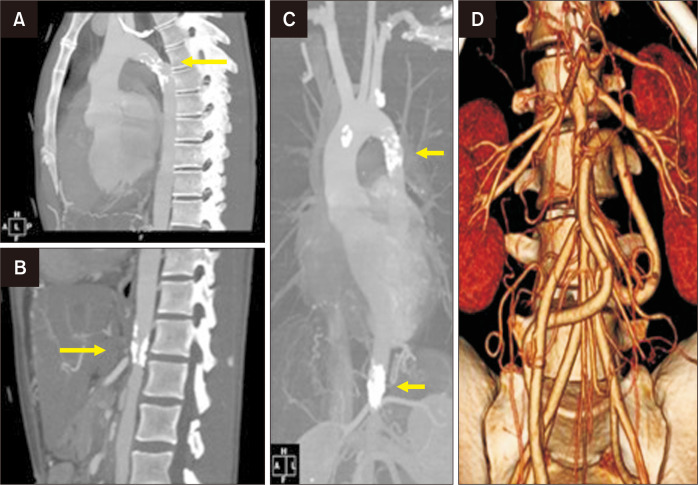 Extra-Anatomic Bypass from Ascending Thoracic Aorta to Abdominal Aorta in Takayasu Arteritis with Middle Aortic Syndrome.