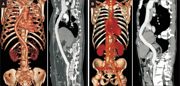 Extra-Anatomic Bypass from Ascending Thoracic Aorta to Abdominal Aorta in Takayasu Arteritis with Middle Aortic Syndrome.