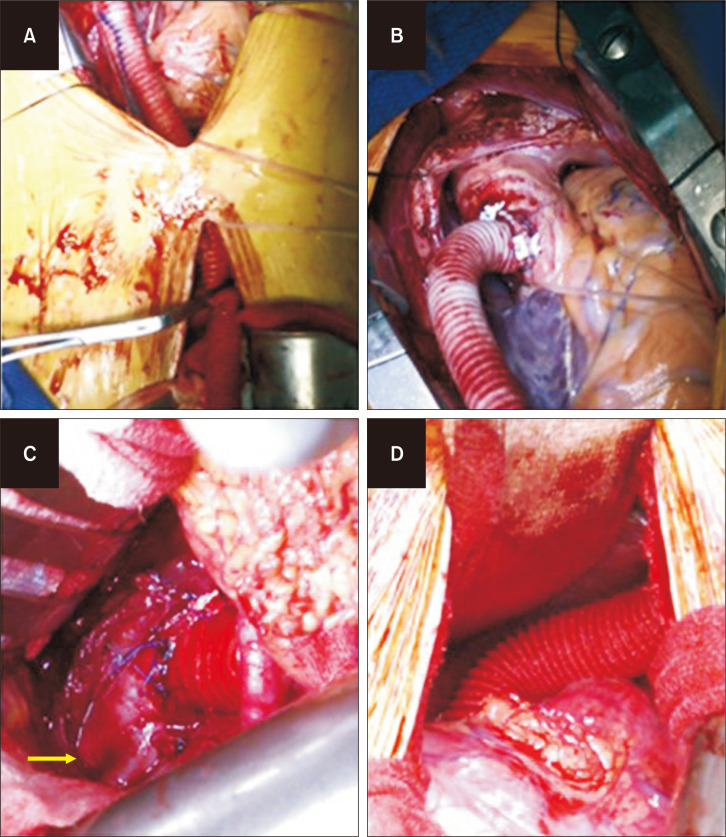 Extra-Anatomic Bypass from Ascending Thoracic Aorta to Abdominal Aorta in Takayasu Arteritis with Middle Aortic Syndrome.