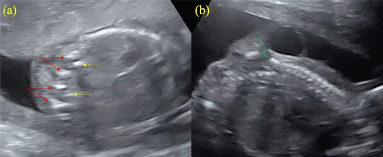 Prenatally diagnosed fetal thoraco-lumbar spine duplication associated with lipomyelomeningocele: An extremely rare case of split cord malformation.