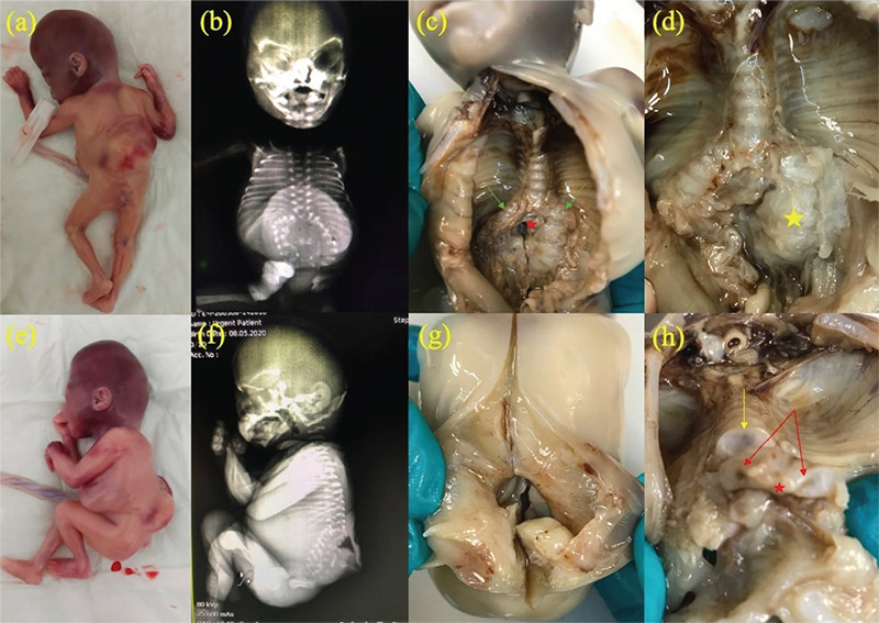 Prenatally diagnosed fetal thoraco-lumbar spine duplication associated with lipomyelomeningocele: An extremely rare case of split cord malformation.