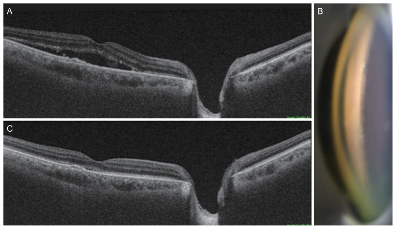 Trabecular Microbypass Stent Insertion for Medically Uncontrolled Glaucoma in a Patient with Central Serous Chorioretinopathy: A Case Report.