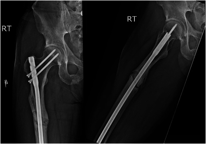 ON Path: outpatient nonunion pathway for lower-extremity nonunions.