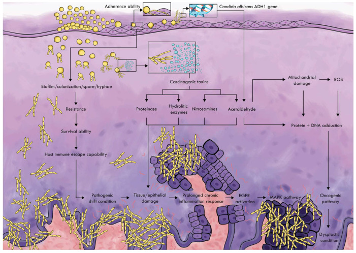 Role of <i>Candida albicans</i> in Oral Carcinogenesis.