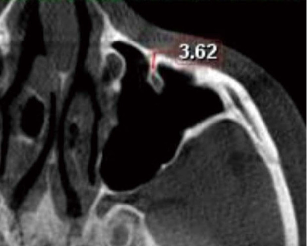 Protrusion of the infraorbital canal into the maxillary sinus: A cross-sectional study in Cairo, Egypt.