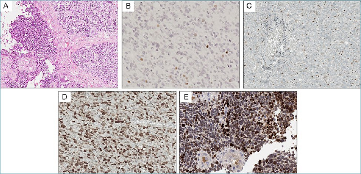 Paediatric-type diffuse high-grade gliomas in the 5th CNS WHO Classification.