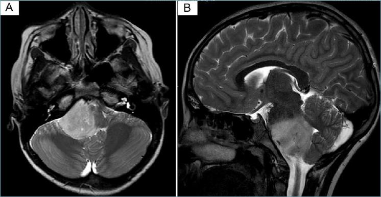 Paediatric-type diffuse high-grade gliomas in the 5th CNS WHO Classification.