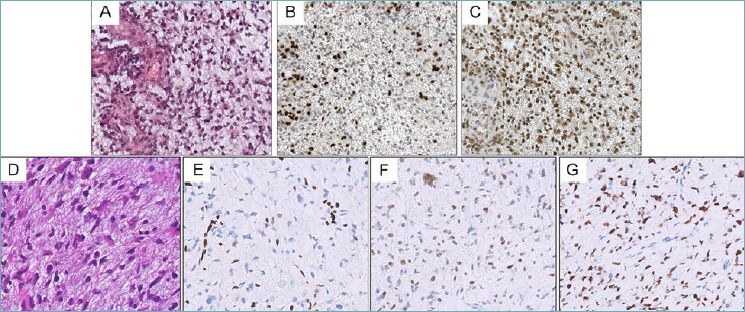 Paediatric-type diffuse high-grade gliomas in the 5th CNS WHO Classification.