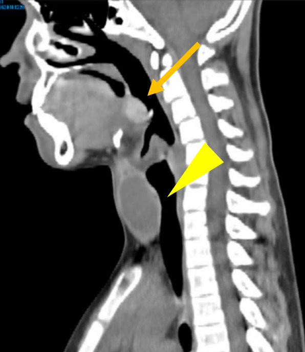 Case report: surgical management of symptomatic pretracheal thyroid gland in a patient with dual ectopic thyroid.