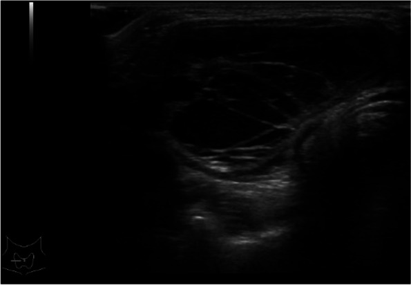 Case report: surgical management of symptomatic pretracheal thyroid gland in a patient with dual ectopic thyroid.