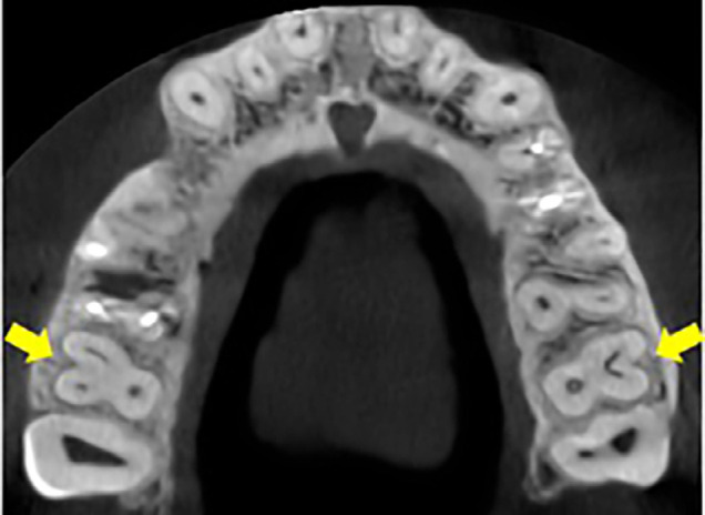 C-shaped Canal System in Maxillary Molars Evaluated by Cone- Beam Computed Tomography in an Argentine subpopulation.