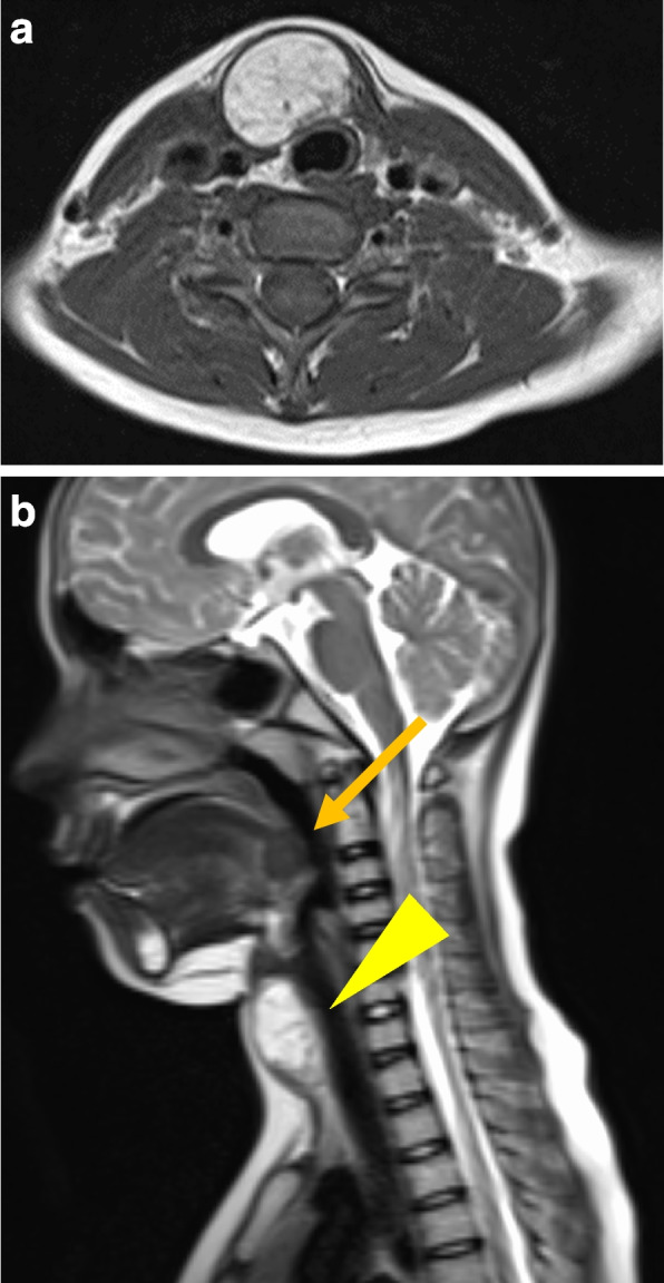 Case report: surgical management of symptomatic pretracheal thyroid gland in a patient with dual ectopic thyroid.