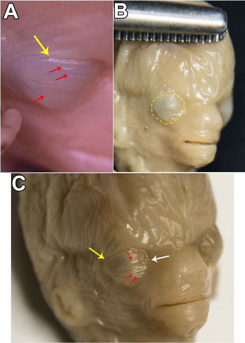 A Systematic Approach of the Intrauterine Morphogenesis of the Human Palpebral Apparatus.