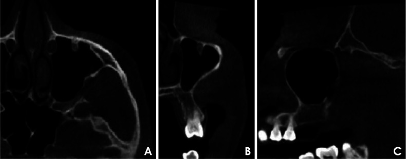 Protrusion of the infraorbital canal into the maxillary sinus: A cross-sectional study in Cairo, Egypt.