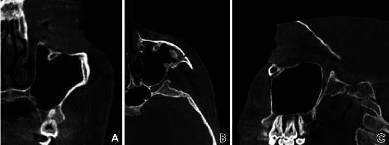 Protrusion of the infraorbital canal into the maxillary sinus: A cross-sectional study in Cairo, Egypt.