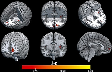 Perspective-taking is associated with increased discriminability of affective states in the ventromedial prefrontal cortex.