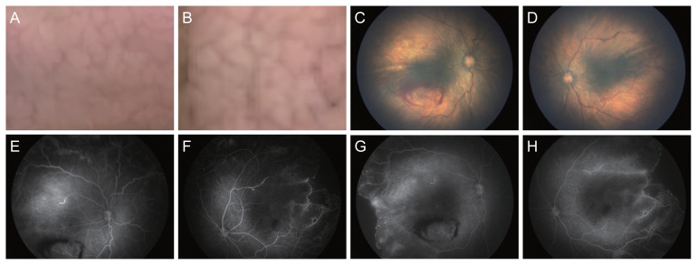 Ischemic Proliferative Retinopathy in a Korean Patient with Cutis Marmorata Telangiectatica Congenita: A Case Report.