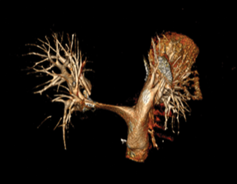 The Secret behind Extreme Hypoxia Tolerance: A "Slow-Growth" Thoracoabdominal Aneurysm.