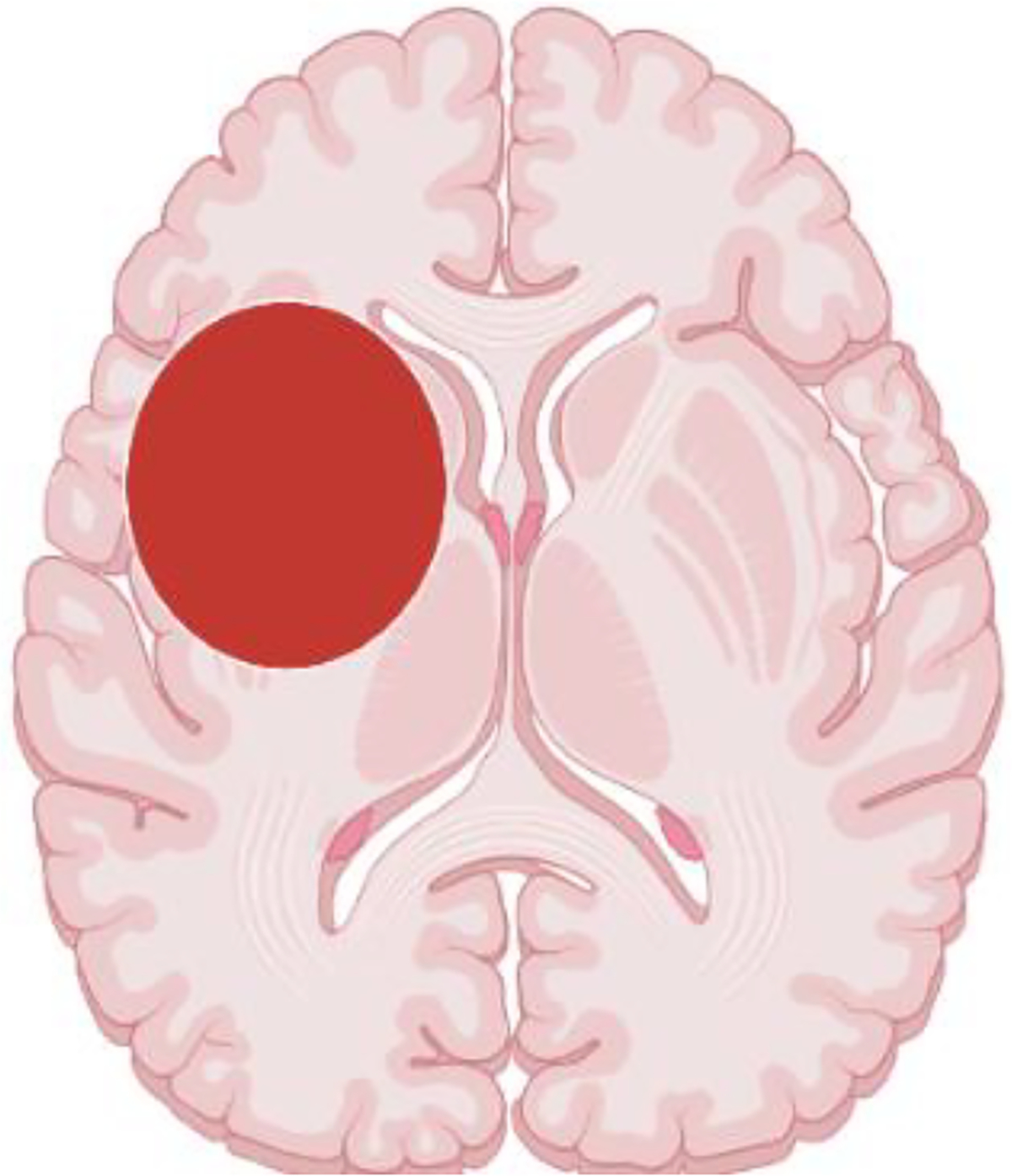 Dental Infections and Risk for Brain Abscess: A Literature Review.