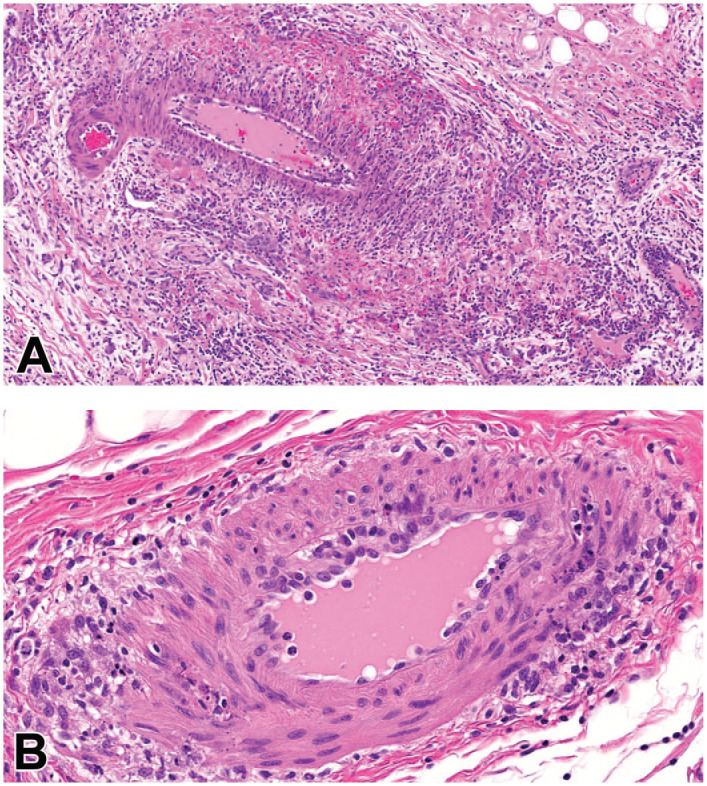 Neutropenia in Cynomolgus Monkeys With Anti-Drug Antibodies Associated With Administration of Afucosylated Humanized Monoclonal Antibodies.