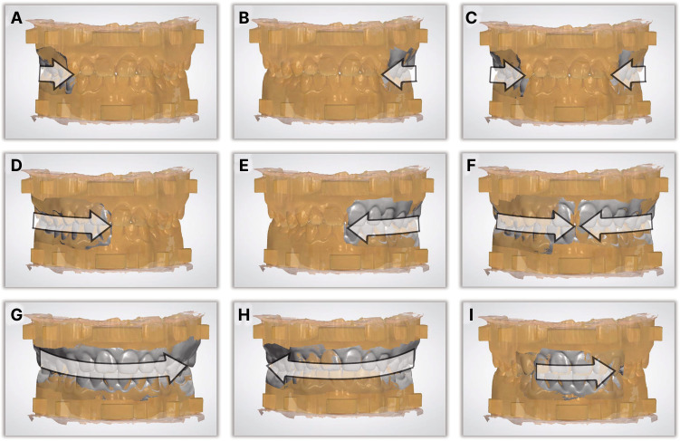 Three-dimensional analysis of the outcome of different scanning strategies in virtual interocclusal registration.