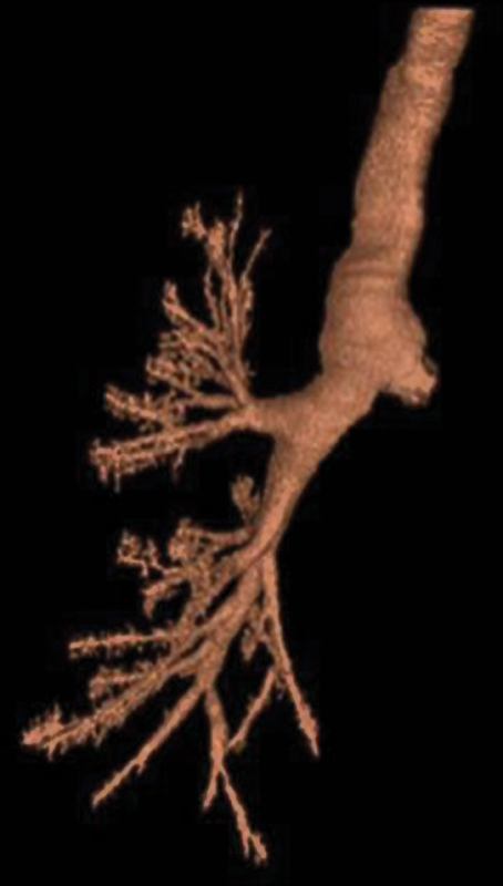 The Secret behind Extreme Hypoxia Tolerance: A "Slow-Growth" Thoracoabdominal Aneurysm.