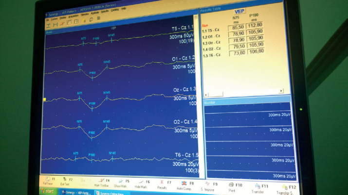 The Correlation of PANSS Scores and P100 Latency in Patients with Schizophrenia and Migrene Hedache Using Visual Evoked Potentials (VEPS) According to Gender and Age.