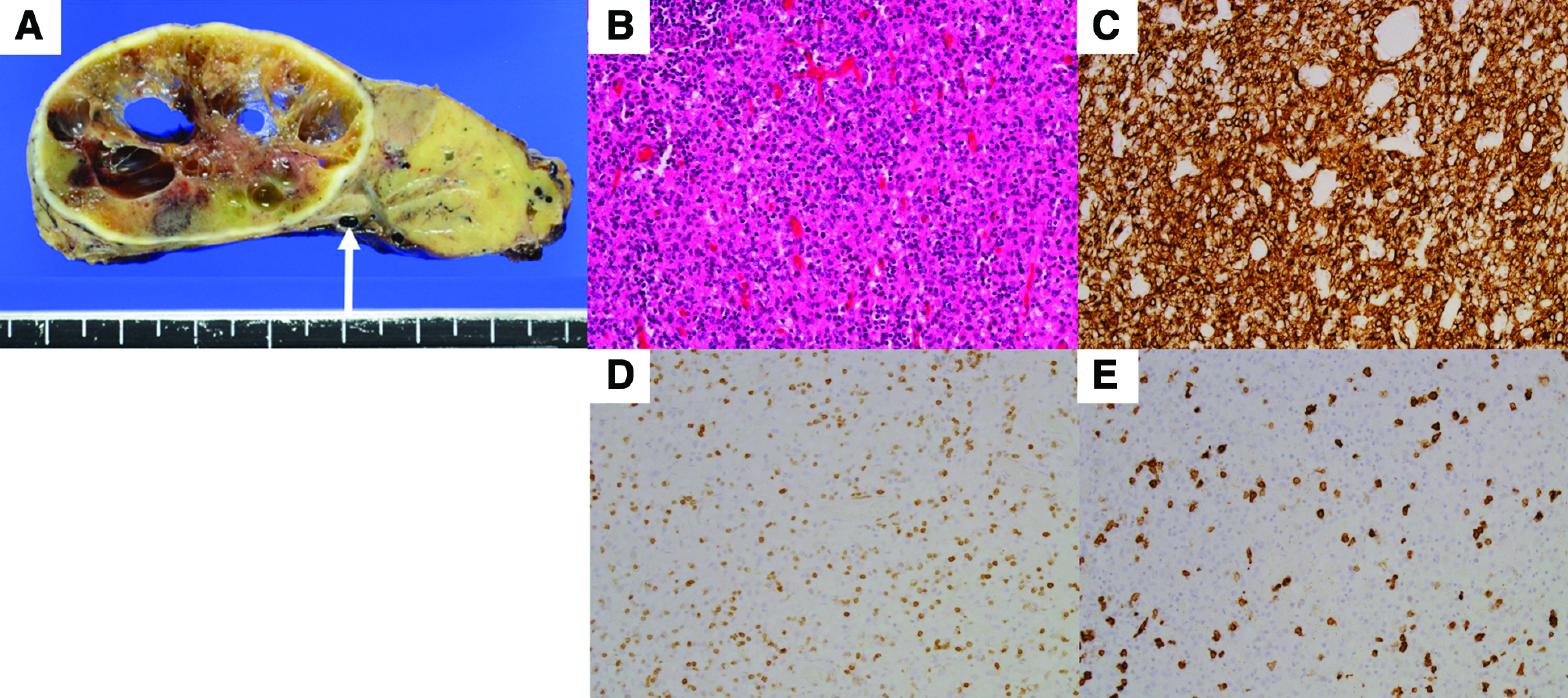 Thymoma-Related Stiff-Person Syndrome with Successfully Treated by Surgery.