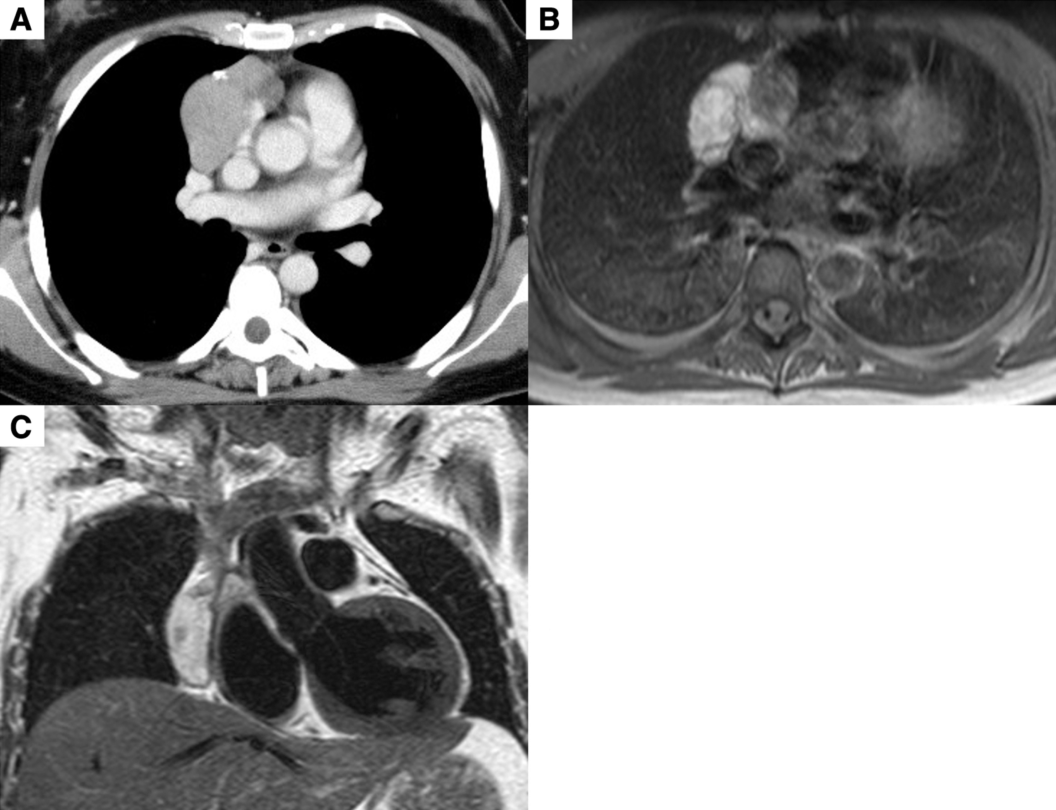 Thymoma-Related Stiff-Person Syndrome with Successfully Treated by Surgery.