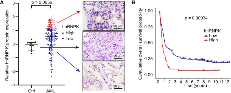 Heterogeneous nuclear ribonucleoprotein K is overexpressed in acute myeloid leukemia and causes myeloproliferation in mice via altered <i>Runx1</i> splicing.