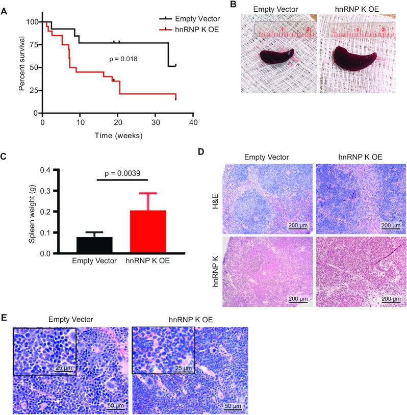 Heterogeneous nuclear ribonucleoprotein K is overexpressed in acute myeloid leukemia and causes myeloproliferation in mice via altered <i>Runx1</i> splicing.