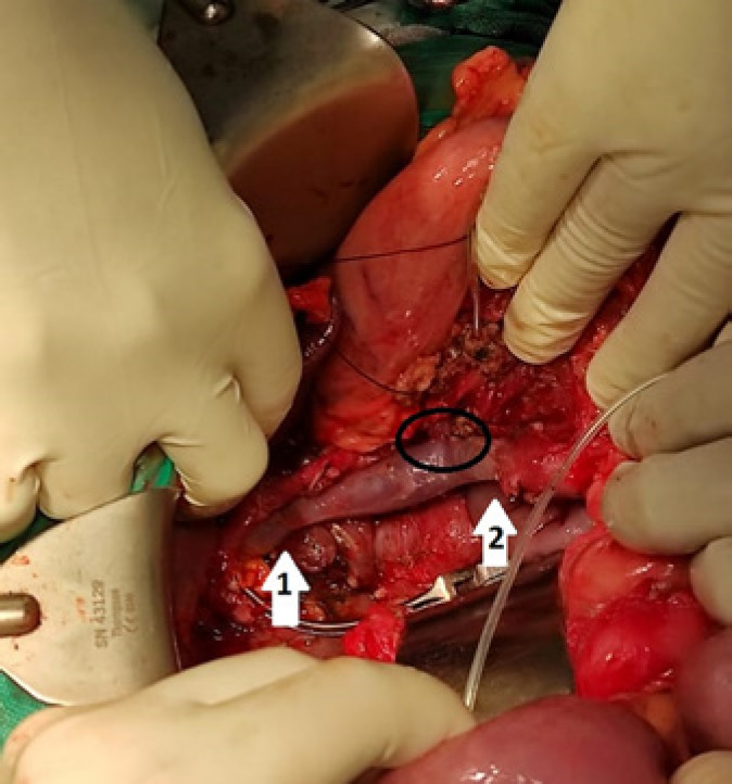 Successful Use of Direct Splenic Vein Anastomosis to the Interposition Internal Jugular Vein Graft after Extended Pancreatoduodenectomy to Avoid Sinistral Portal Hypertension.