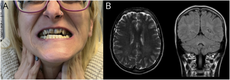 Diagnostic Efficacy of Genetic Studies in a Series of Hereditary Cerebellar Ataxias in Eastern Spain.