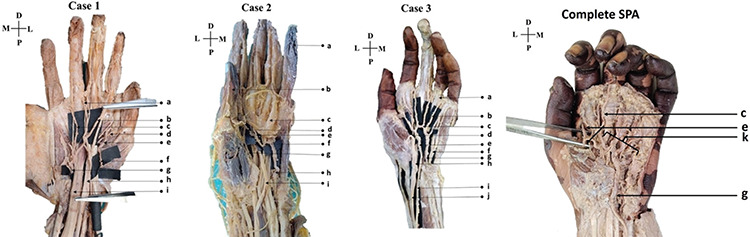 Variations in Superficial Palmar Arch: Case Series with Clinico-anatomical Perspective.